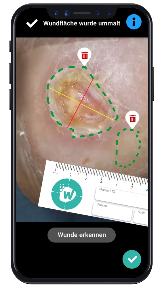 Automatische Wundvermessung
